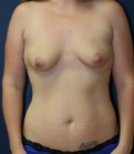 Feel Beautiful - Mommy Makeover San Diego, 12 - Before Photo